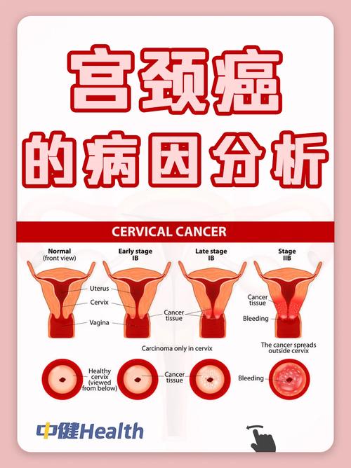 得了宫颈癌会传染吗？女性朋友们关心的问题来啦